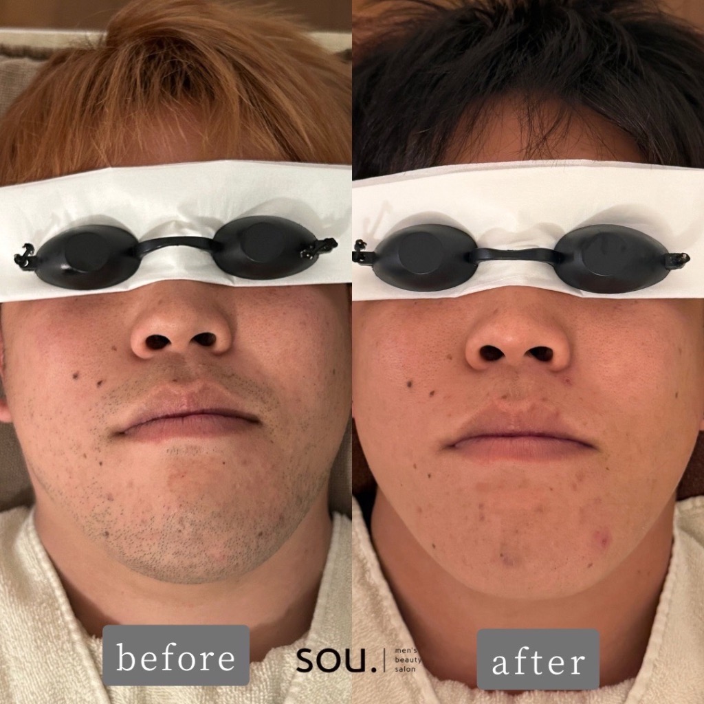 以前、金沢にある医療脱毛クリニックに通っていたお客様からお聞きしたお話をご紹介させていただきます💡